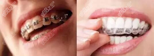 3000块可以矫正牙齿吗m.8682.cc