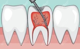 根尖周炎多数是牙神经发炎造成的