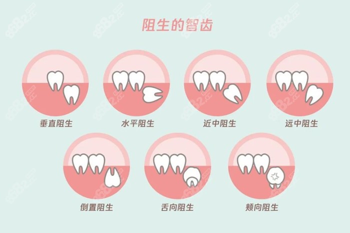 运城拔智齿的价格不算贵www.8682.cc