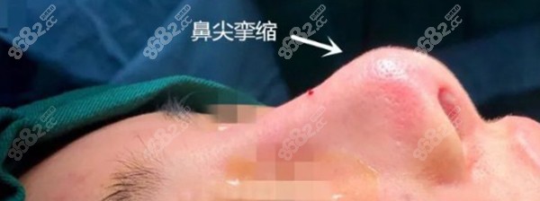 肋骨隆鼻鼻尖会回缩