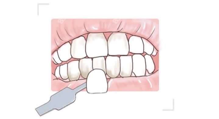 广州壹加壹口腔牙齿贴面做得好86821.cc分享