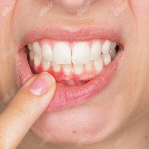 牙龈肿是有龈下结石吗?