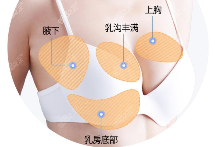 芙莱思整形做脂肪丰胸脂肪填充部位