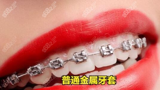 钢牙快还是隐形快m.8682.cc