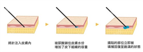 余永刚医生玻尿酸注射技术高超