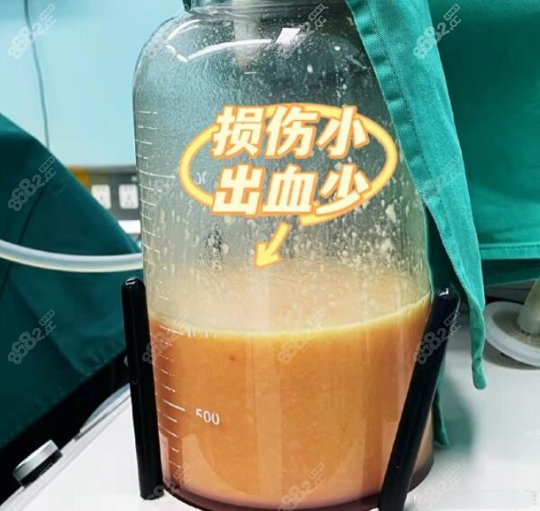 大腿环吸抽出的脂肪8682网分享