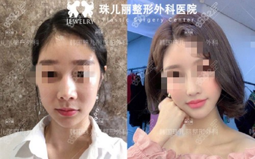 韩国珠儿丽歪鼻矫正前后对比图
