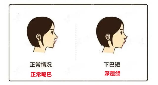 深覆合和正常牙齿的对比