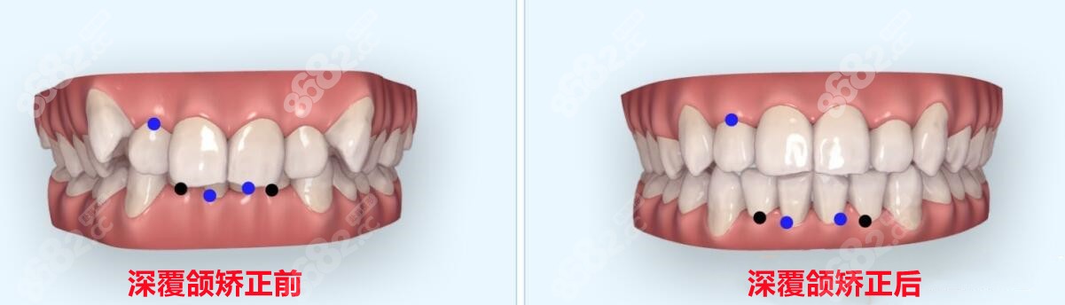 深覆合矫正前后牙齿咬合变化