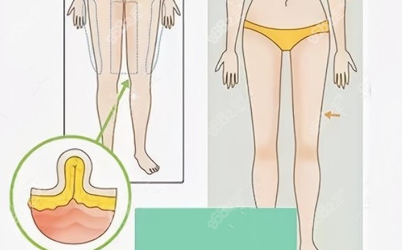 大腿环吸4000cc腿围变化对比图片