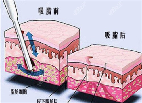 成都艾米丽潘红伟吸脂术后对比