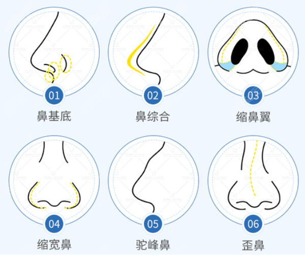 杭州清沐整形隆鼻多少钱