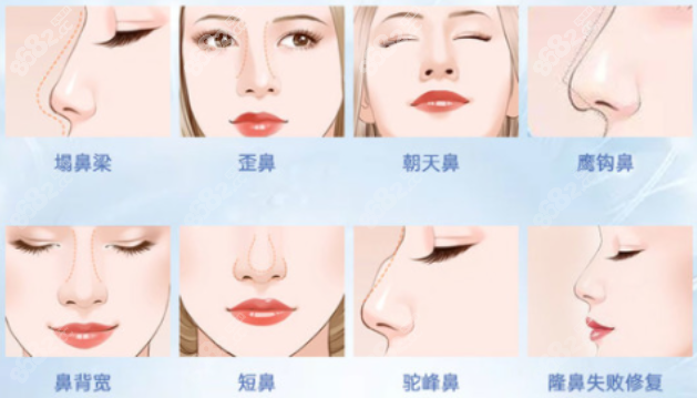 李保锴医生做鼻子多少钱