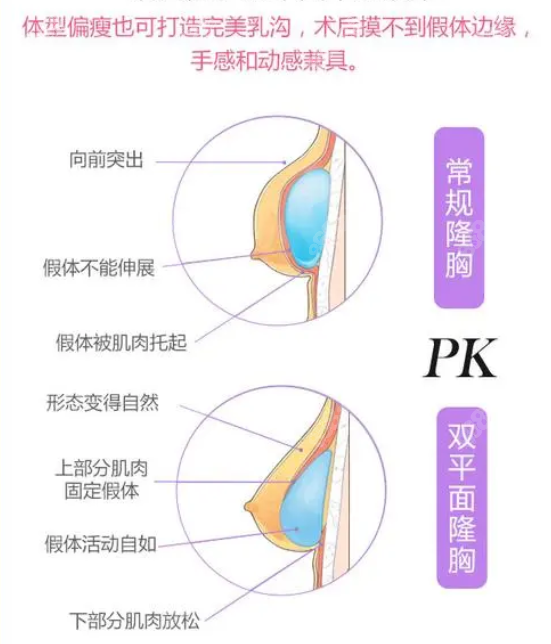 大连沙医生假体隆胸怎么样