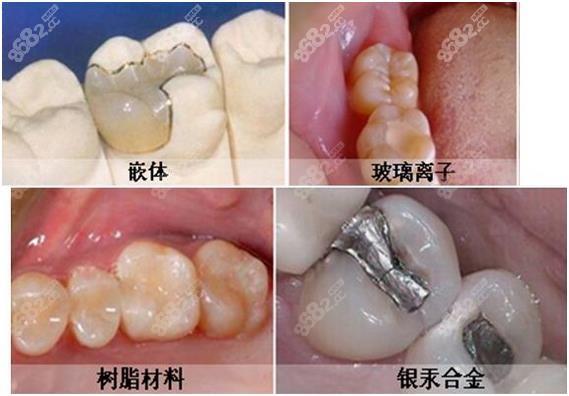 各种不同的补牙材料