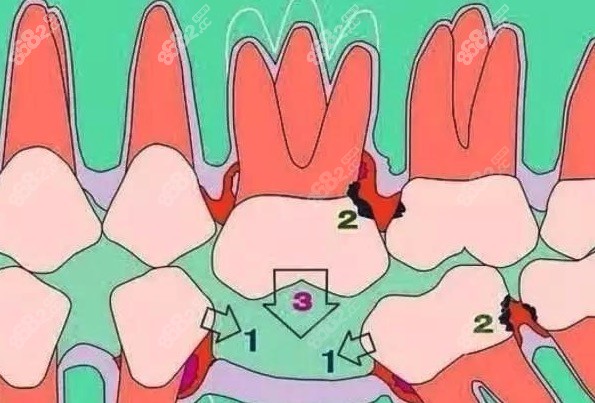 缺牙后牙齿倾斜