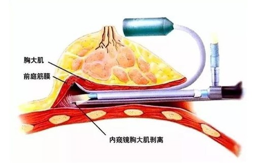 温州艺星做假体丰胸怎么样