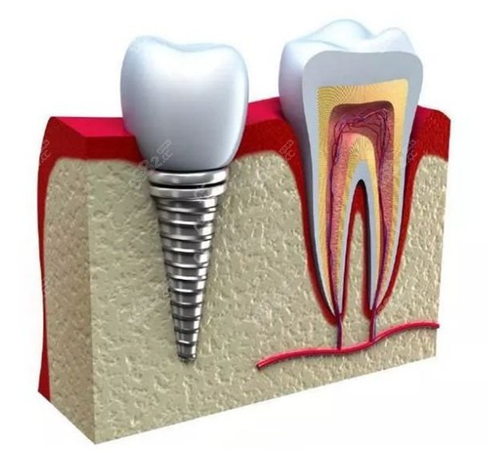 苏州吴江美奥口腔种植牙怎么样