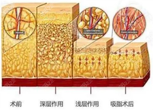 罗忠振医生吸脂价格