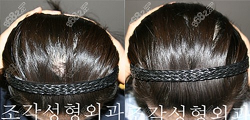 韩国雕刻整形外科医院后脑勺填充实例