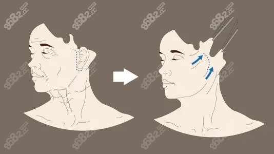 做拉皮提升的术后对比图