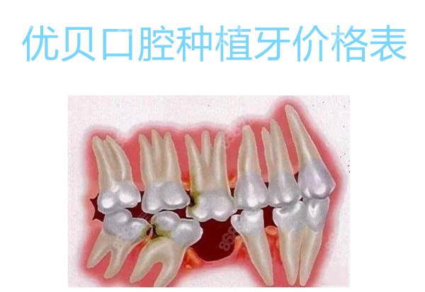 优贝口腔种植牙价格表