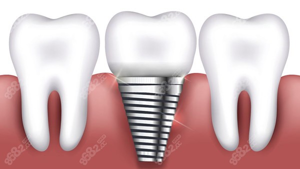种植牙骨粉骨膜的作用是什么