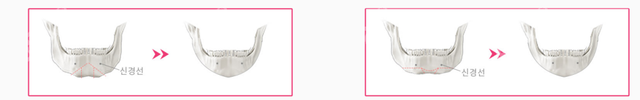 伊美芝下颌尖脸两种手术示意图