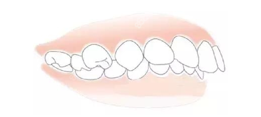 40岁矫正牙齿会有后遗症吗？