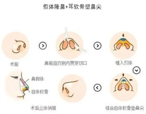 上海薇琳<!--<i data=20240705-sp></i>-->医生隆鼻技术娴熟