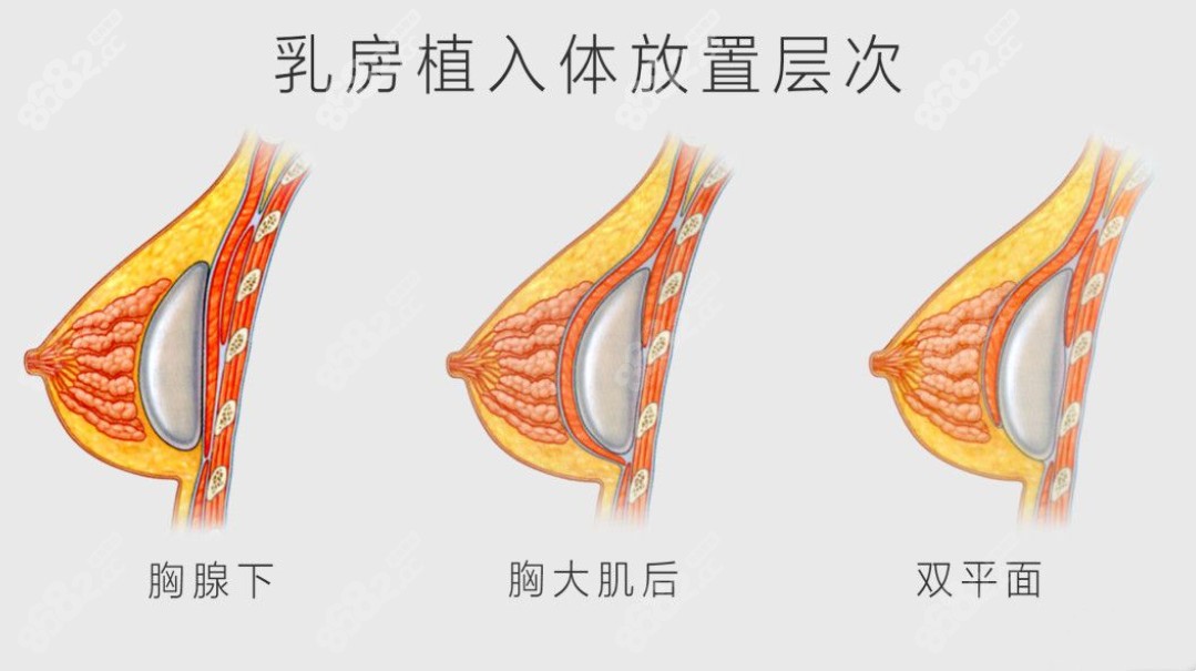 韩国欧佩拉整形医院隆胸价格表