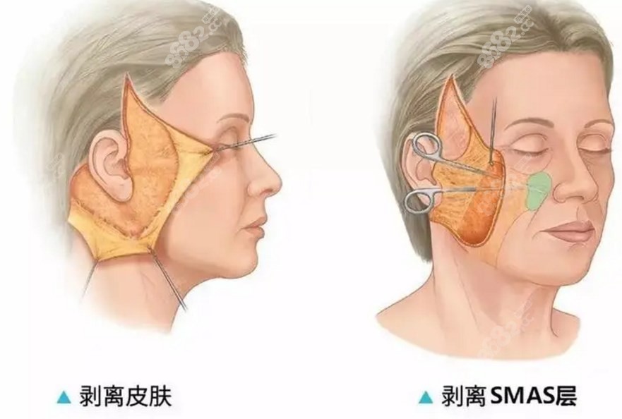 拉皮手术剥离范围越大越有成效吗