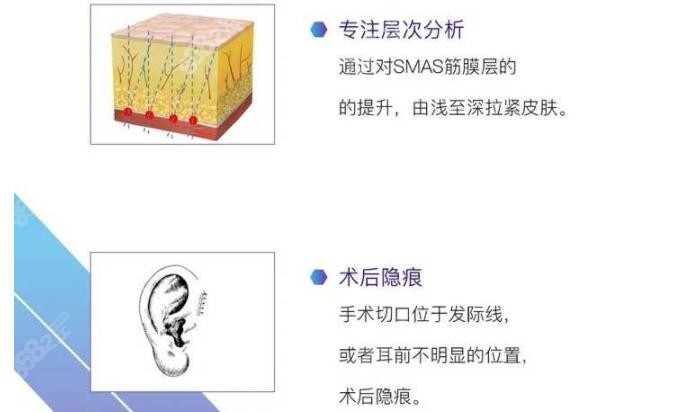 筋膜提升的优势点