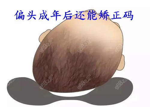 偏头成年人还能矫正吗？