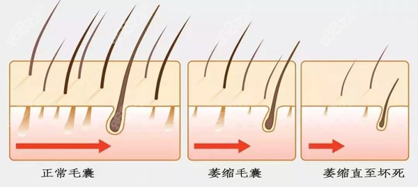 毛囊状态越来越差直至萎缩闭合