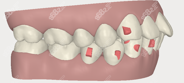 40岁龅牙牙齿矫正图片参考（m.8682.cc）