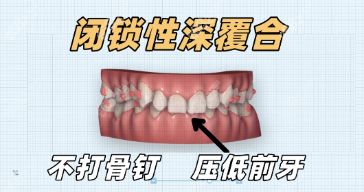 闭锁性深覆合矫正图示