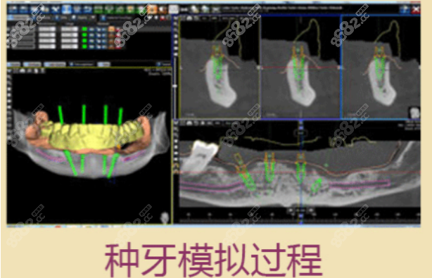 京韩口腔医院种植牙模拟过程
