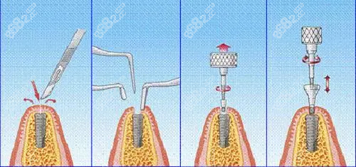 郑州植得口腔种植牙过程