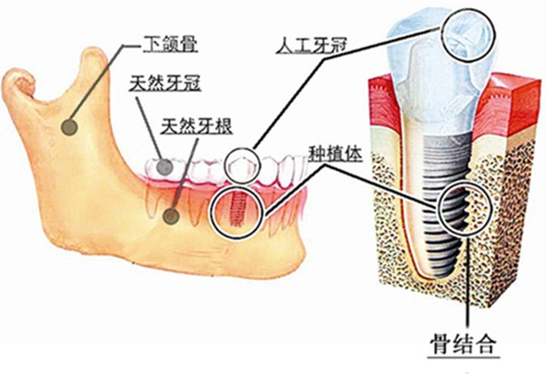 种植牙在牙骨内的图