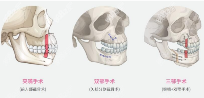 正颌手术
