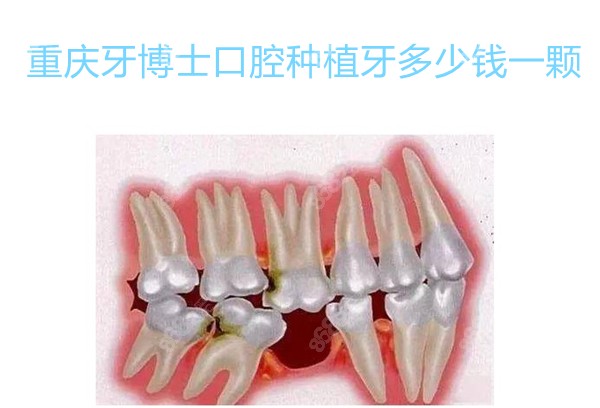 重庆牙博士口腔种植牙多少钱一颗