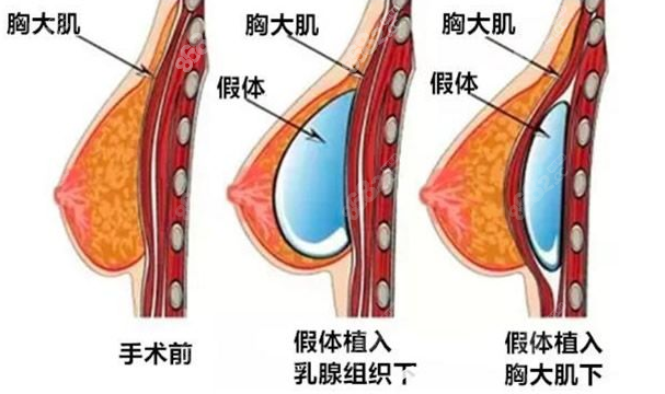 假体隆胸取出费用贵吗？