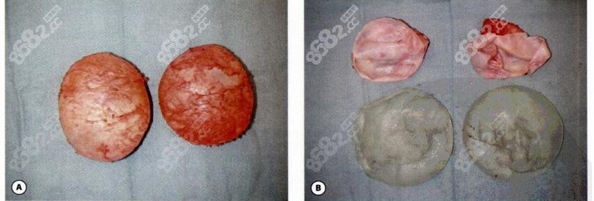 假体隆胸后摸起来褶皱不平的原因是出现包膜挛缩