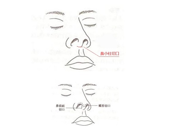 北京泛美王军隆鼻技术要点一：鼻孔内切口隆鼻