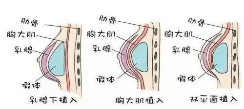 广州隆胸好的整形医院推荐