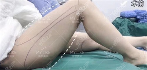 <!--<i data=20240705-sp></i>-->腿部吸脂术前