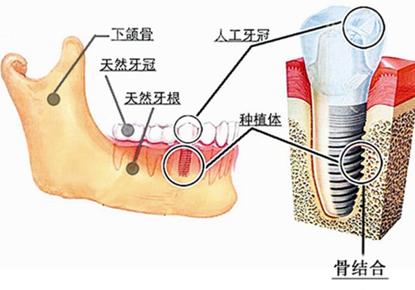 种植牙与牙骨的结合