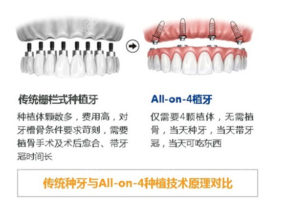 all on 4种植牙和传统种植牙的对比