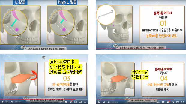 韩国欧佩拉颧骨整形怎么样？优势展示